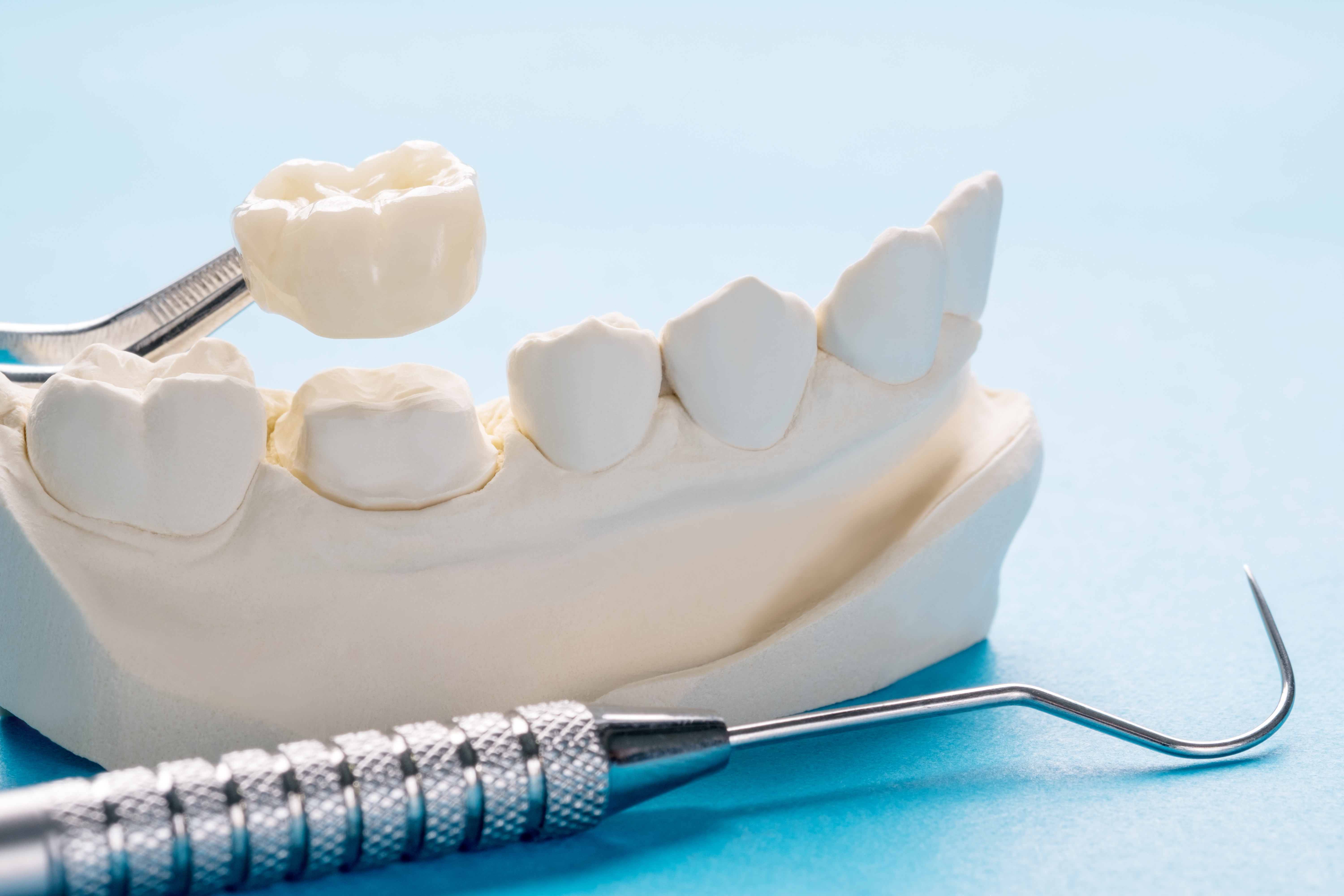 Dental Crowns in Des Moines