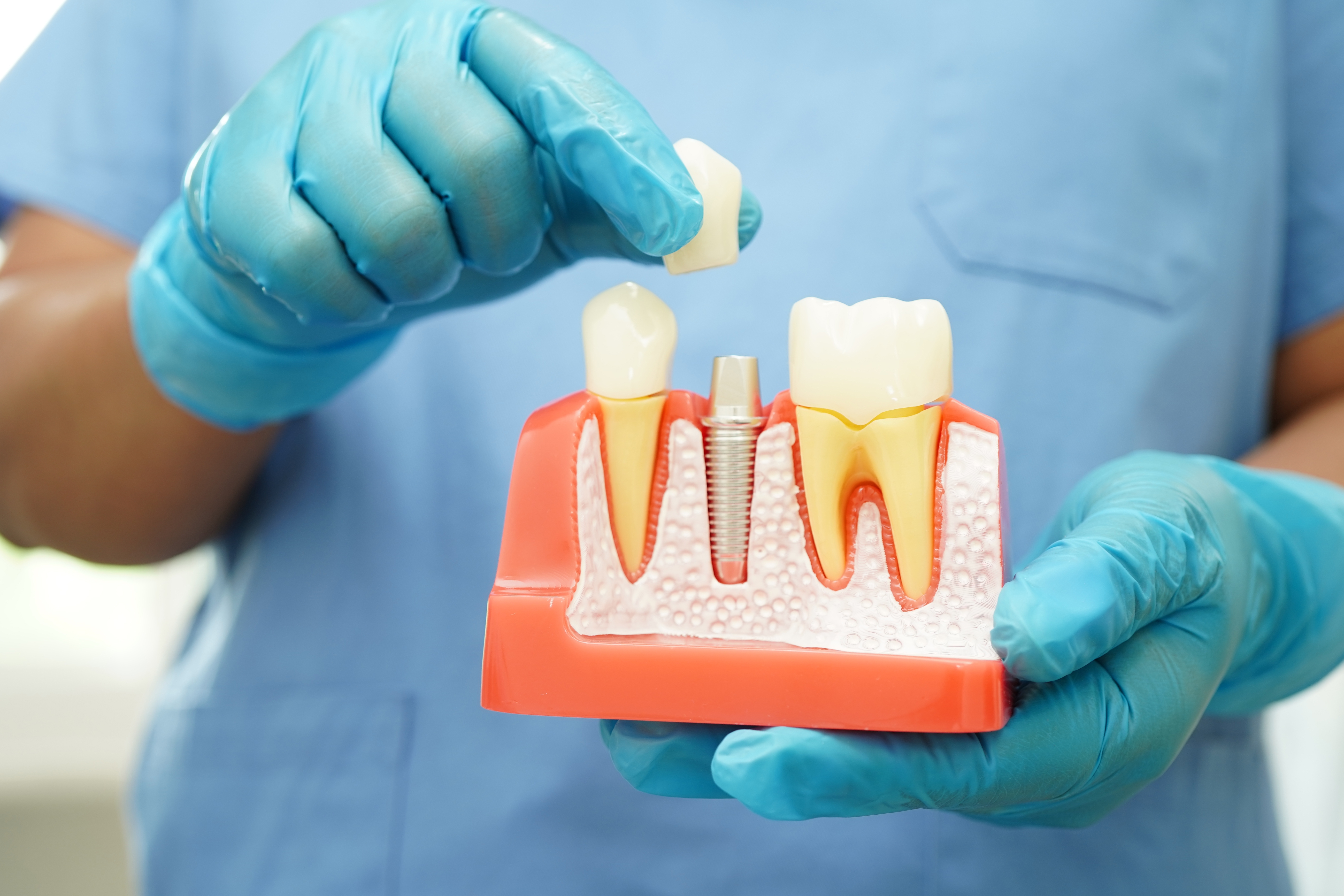 Implant Dentist in Des Moines